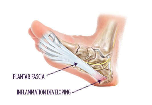 Why Your Plantar Fasciitis Isn't Healing: A Regenerative Approach to Chronic Heel Pain